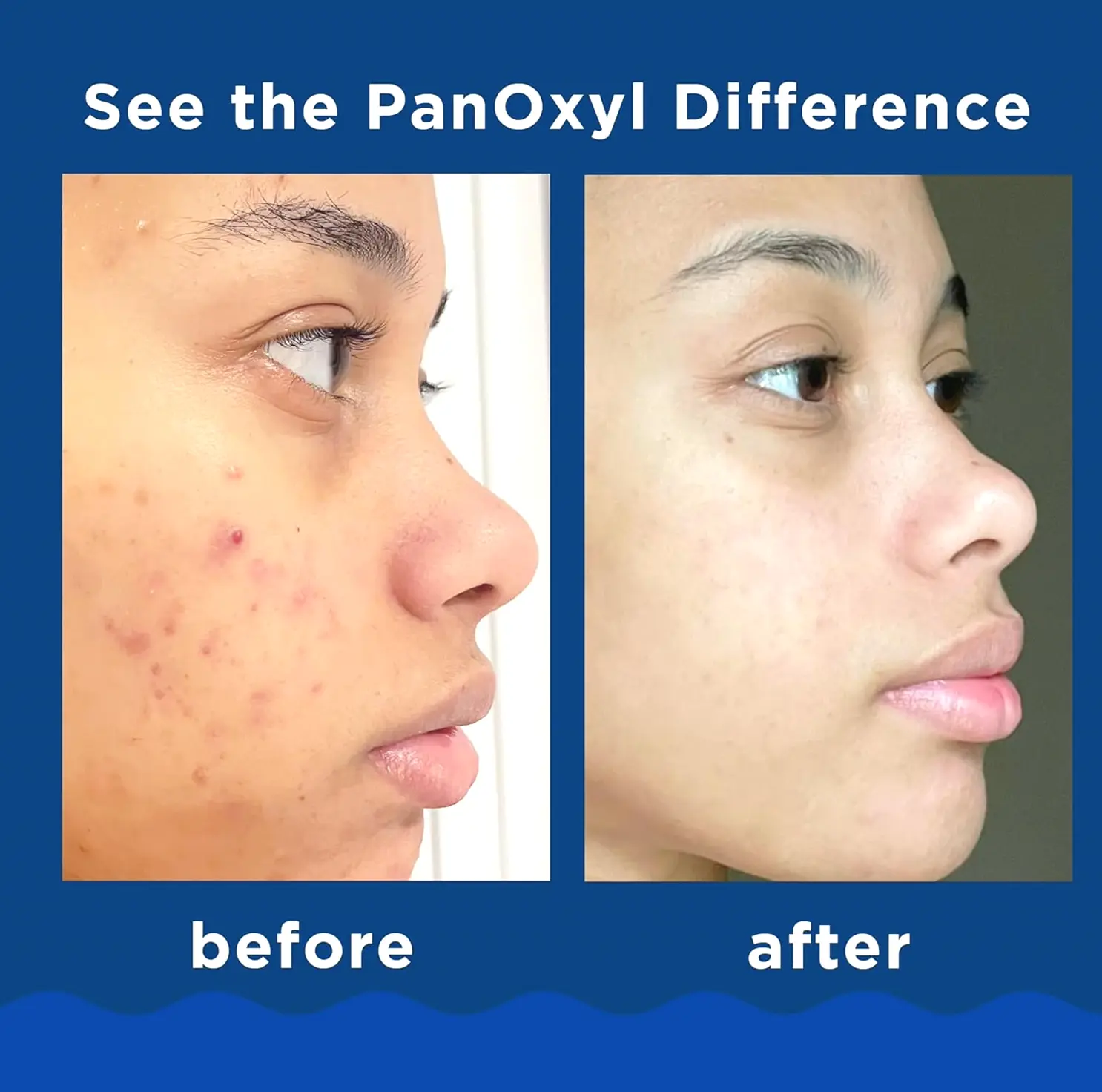 PanOxyl's Pimple Cleanser BP 10% Strength, 5.5 Oz